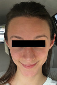 Botox Before and After Pictures Monroe, LA and Southlake, TX