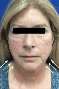 Cosmetic Dermatology Before and After Pictures Monroe, LA and Southlake, TX