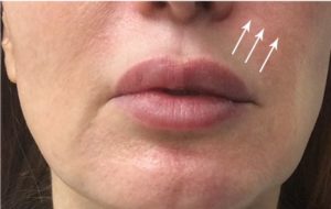 Lip Augmentation Before and After Pictures Monroe, LA and Southlake, TX