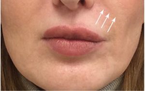 Lip Augmentation Before and After Pictures Monroe, LA and Southlake, TX