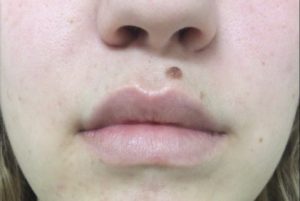 Lip Augmentation Before and After Pictures Monroe, LA and Southlake, TX