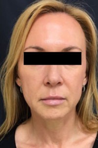 Liquid Facelift Before and After Pictures Monroe, LA and Southlake, TX