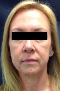 Liquid Facelift Before and After Pictures Monroe, LA and Southlake, TX