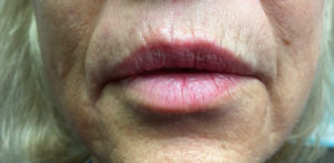 Cosmetic Dermatology Before and After Pictures Monroe, LA and Southlake, TX