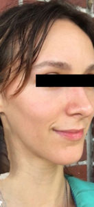 Cosmetic Dermatology Before and After Pictures Monroe, LA and Southlake, TX