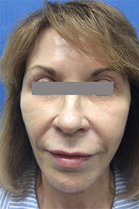 Botox Before and After Pictures Monroe, LA and Southlake, TX