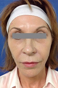Sculptra Before and After Pictures Monroe, LA and Southlake, TX
